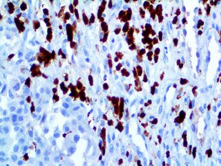 IHC of S100P on an FFPE Melanoma Tissue